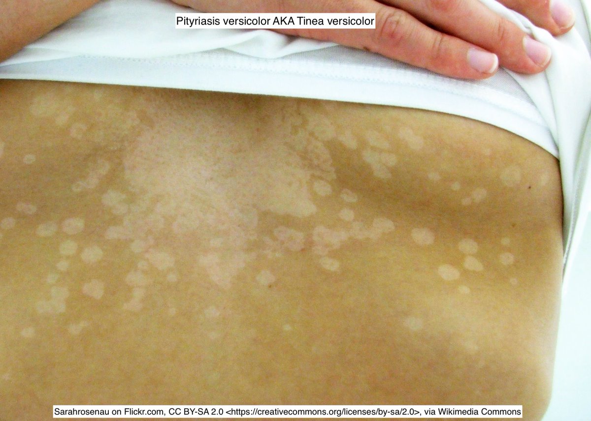 Path4People's tweet image. Can we talk about the confusion of Malassezia species 🍝 😵‍💫 

It&apos;s normal flora in skin and loves Olive 🫒 oil.

But when it overgrows it&apos;s called Pityriasis versicolor AND/OR Tinea versicolor.

Why not just call it Malassezia versicolor?  🫤 🤷 

#pathx #medx #fammed #dermpath