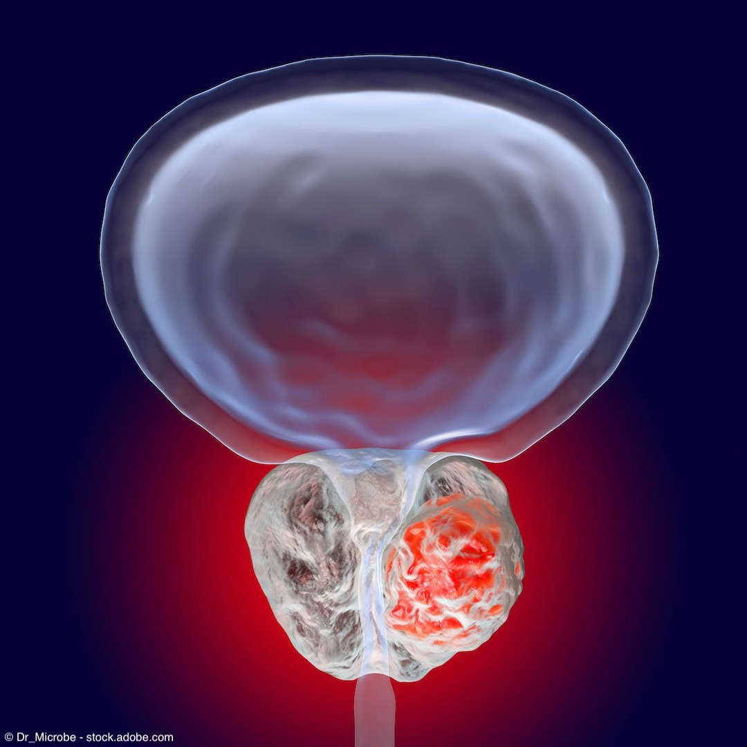 ArteraAI (@arteraai) on Twitter photo The Phase 3 PROSTATE-IQ trial, recently featured in <a href="/UrologyTimes/">Urology Times</a>, is evaluating how the ArteraAI Prostate Test can help tailor ADT decisions after prostatectomyāreducing toxicity, preserving QoL, and advancing personalized prostate cancer care:
urologytimes.com/view/phase-3-t⦠The Phase 3 PROSTATE-IQ trial, recently featured in <a href="/UrologyTimes/">Urology Times</a>, is evaluating how the ArteraAI Prostate Test can help tailor ADT decisions after prostatectomyāreducing toxicity, preserving QoL, and advancing personalized prostate cancer care:
urologytimes.com/view/phase-3-tā¦