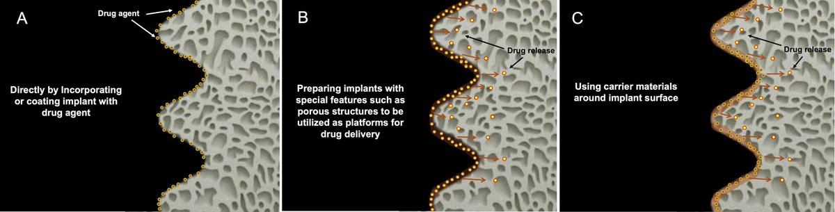My recently published paper discusses the main methods used for the local administration of drugs around dental implants. 

journals.lww.com/jioh/fulltext/…