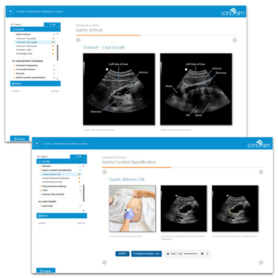 Gastric Ultrasound: Advanced Clinical Ultrasound Module is now available!

This course provides training on using ultrasound to assess gastric fullness and manage aspiration risk. Very timely in the era of GLP-1 receptor agonists.

bit.ly/42ROkEY