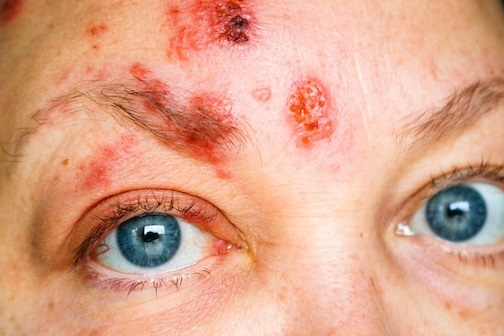 Neurology Today (@neurologytoday) on Twitter photo Low-dose valacyclovir alleviated pain from post-herpetic neuralgia associated with zoster eye disease, enabling patients to lower dosages of other more toxic pain meds. The study supports valacyclovir as a safe alternative. 💊 <a href="/nyugrossman/">NYU Grossman School of Medicine</a> @AANMember
hubs.ly/Q03kCyBC0 Low-dose valacyclovir alleviated pain from post-herpetic neuralgia associated with zoster eye disease, enabling patients to lower dosages of other more toxic pain meds. The study supports valacyclovir as a safe alternative. 💊 <a href="/nyugrossman/">NYU Grossman School of Medicine</a> @AANMember
hubs.ly/Q03kCyBC0