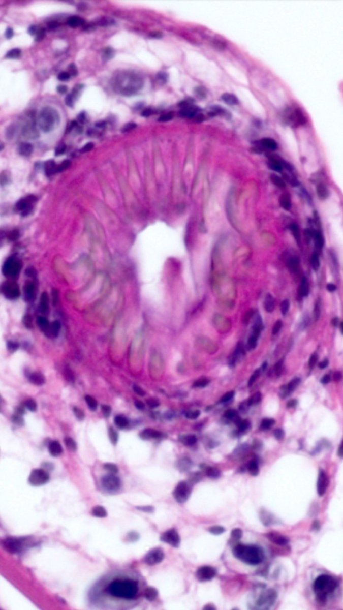 smlungpathguy's tweet image. #Pathbugs #crittersontwitter #pathology #pulmpath