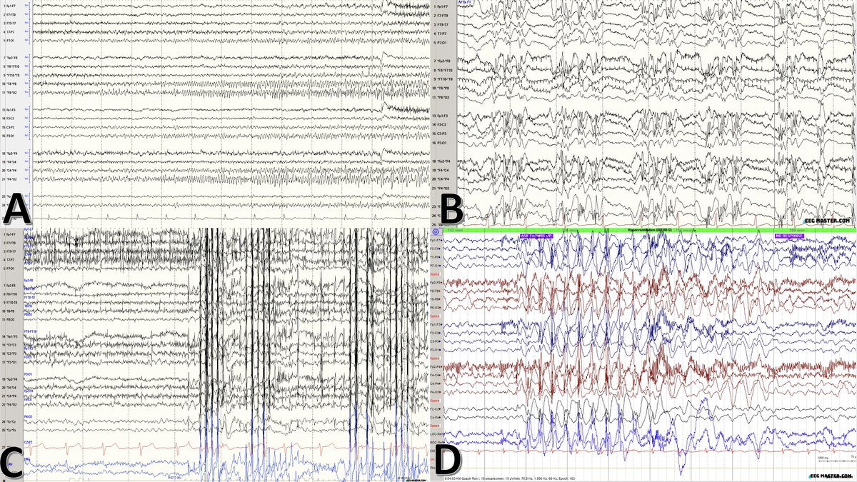 There are 4 patients, with EEG shown below. For which patient, Ethosuxamide would be most appropriate? (Patient B and C had jerking movements;  Patient D had episode of unresponsiveness.) Click on the link to see options, submit answer &amp; view explanation.  eegmaster.com/eegmaster/quiz…