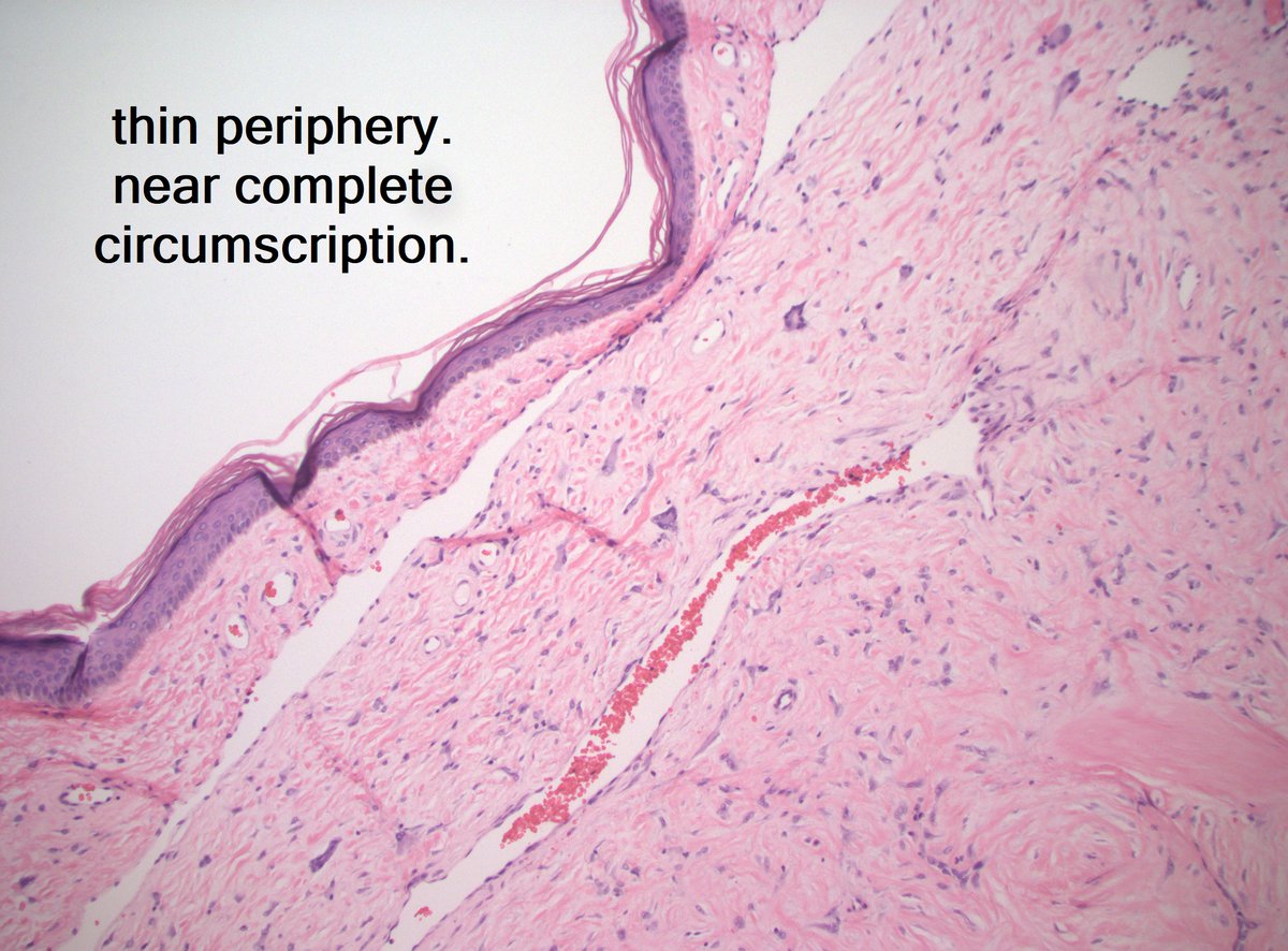 20s M postauricular polypoid mass. Dx?

#dermpath #PathTwitter #pathX