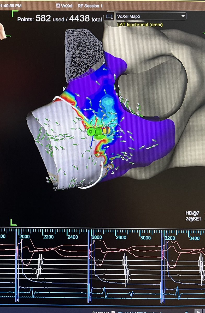 SoFloAbbottEP's tweet image. AVRT! Open window mapping of a concealed left lateral accessory pathway using the HD Grid. One burn term (1.3 seconds). 

#AbbottProud #MapMoreBurnLess #HDGrid #TactiFlex