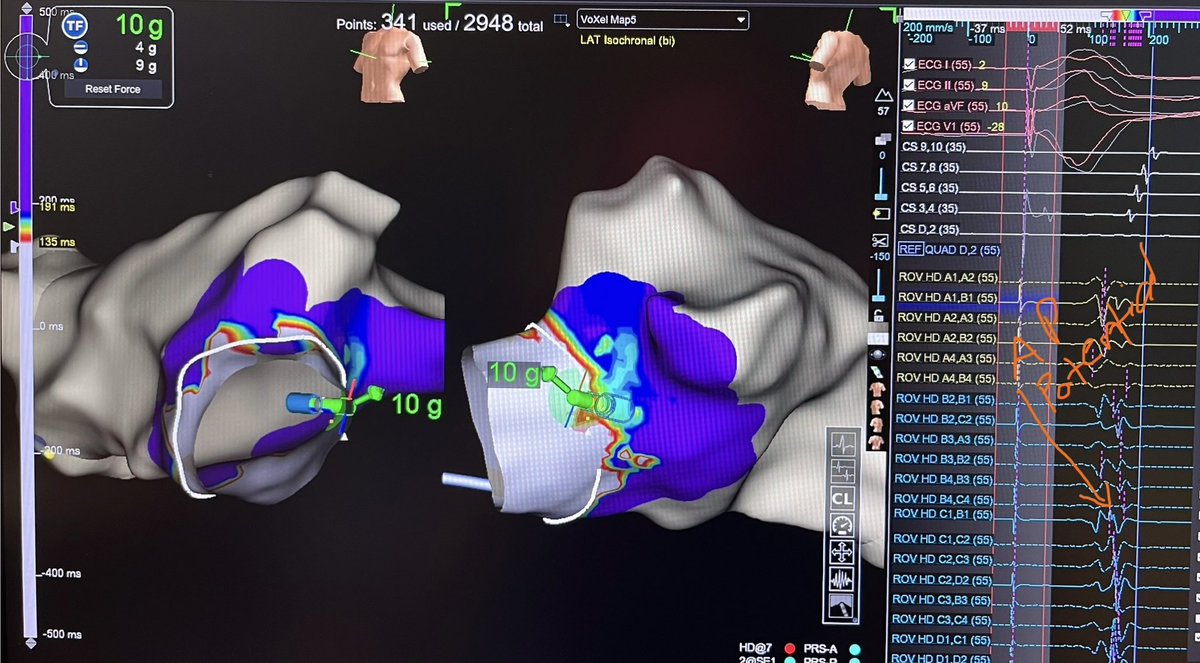 SoFloAbbottEP's tweet image. AVRT! Open window mapping of a concealed left lateral accessory pathway using the HD Grid. One burn term (1.3 seconds). 

#AbbottProud #MapMoreBurnLess #HDGrid #TactiFlex