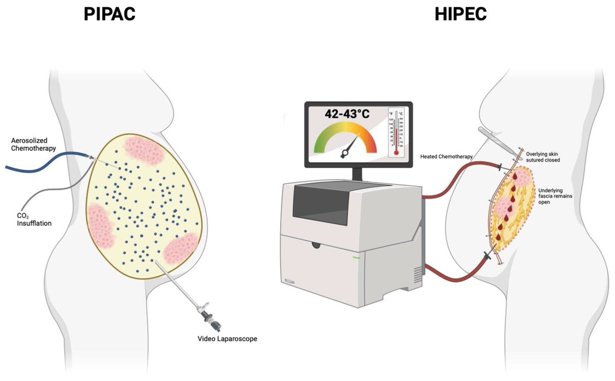 🤗 Check out #review: State-of-the-Art Therapy in Peritoneal Carcinomatosis Management #PeritonealCarcinomatosis
<a href="/MdpiOnco/">Onco_MDPI</a>  <a href="/MDPIOpenAccess/">MDPI</a> 
👨‍🎓 Author: by Elbek Fozilov, Anthony Weng and Snigdha Kanadibhotla
👉 mdpi.com/2673-7523/5/2/…