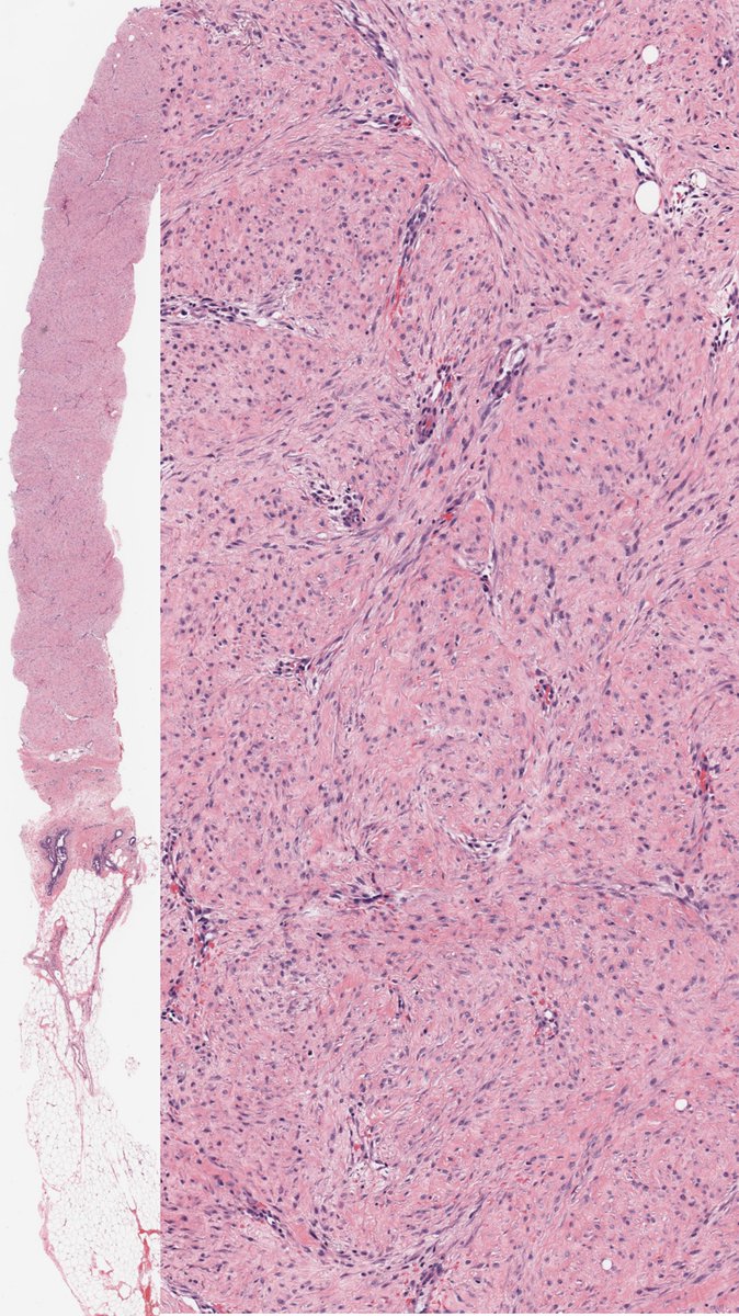 Charles Herndon (@drcyclopath) on Twitter photo Breast core needle biopsy. Diagnosis?
A) Myofibroblastoma
B) Myoid hamartoma
C) Fibrous mastopathy
D) Fibromatosis
#BreastPath #Pathology #PathTwiter 
π¬dpa-dapa.com/public/displayβ¦ Breast core needle biopsy. Diagnosis?
A) Myofibroblastoma
B) Myoid hamartoma
C) Fibrous mastopathy
D) Fibromatosis
#BreastPath #Pathology #PathTwiter 
π¬dpa-dapa.com/public/displayβ¦