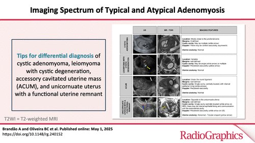 Ana Villanueva (@anavillanuevaca) on Twitter photo 📣📚 Hot off the press!
💛 Typical and atypical adenomyosis
pubs.rsna.org/doi/epdf/10.11…
#radres #MedEd #FOAMmed #RGphx #endometriosis #adenomyosis <a href="/FOAMrad/">FOAMrad</a> <a href="/futureradres/">Future Radiology Residents</a> <a href="/ESUR_JN/">ESUR Junior Network</a> <a href="/EndoEICE/">EICE</a> <a href="/lucianachamiec1/">luciana@chamie.com.br</a> 📣📚 Hot off the press!
💛 Typical and atypical adenomyosis
pubs.rsna.org/doi/epdf/10.11…
#radres #MedEd #FOAMmed #RGphx #endometriosis #adenomyosis <a href="/FOAMrad/">FOAMrad</a> <a href="/futureradres/">Future Radiology Residents</a> <a href="/ESUR_JN/">ESUR Junior Network</a> <a href="/EndoEICE/">EICE</a> <a href="/lucianachamiec1/">luciana@chamie.com.br</a>
