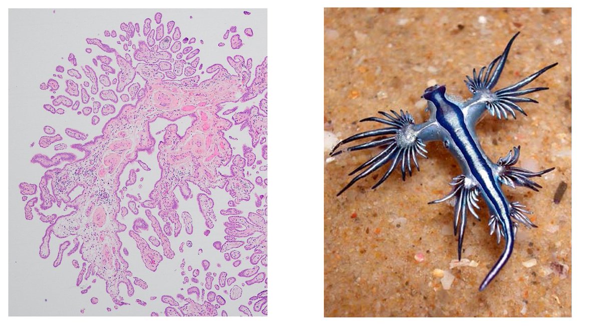 This brought me joy this morning during our unknown sessions. The dx was papillary mesothelioma, but my brain saw one of my favorite critters, #Glaucusatlanticus. It's a type of poisoninous sea slug that eats the stinging cells of jellyfish. 
#pathart #pathx  #PathTwitter