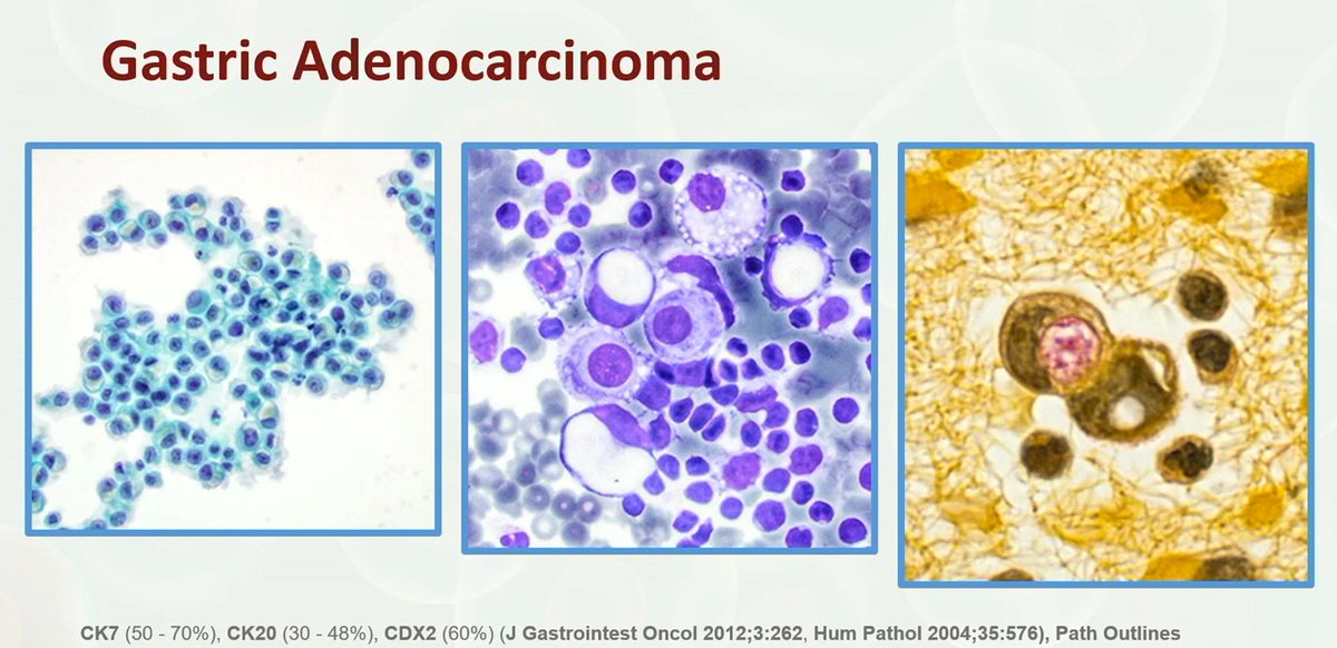Cytology
Gastric Adenocarcinoma

Dr. Siddiqui #USCAP25 #pathology #PathX #PathBoards