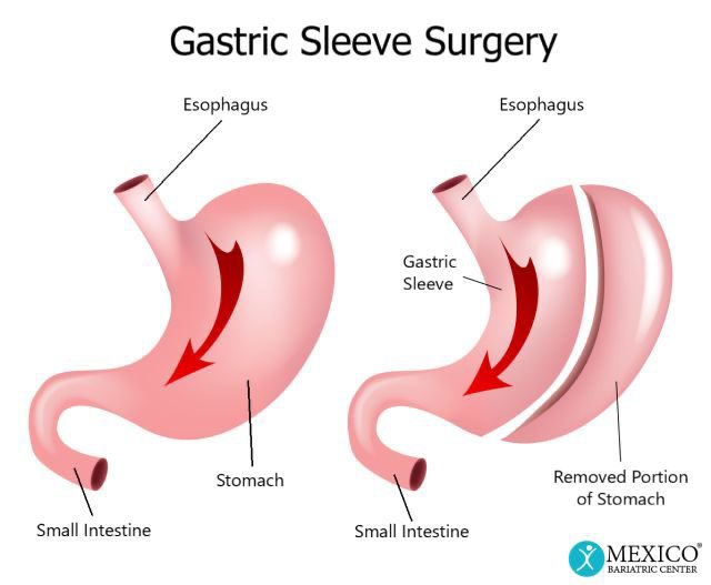 TheDigestiveIn's tweet image. Sleeve gastrectomy can reduce hunger hormones and help you feel full faster—science-backed weight loss
#DigestiveHealthInstitute #uppercaseWithBumrah #Modi4APDevelopment #RealActivNoAddedSugar #AmaravatiRestart #HDFCMutualFunds #PMModi #WAVES2025 #MAROON5xLISA_PRICELESS #TABLOxRM