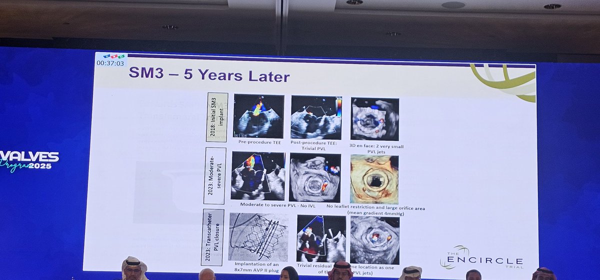 Salem Assiri, MD, FACC (@assiri99) on Twitter photo #TMVR M3
#GISValves2025 #InterventionalCardiology #GulfVoices #HeartTeam #FromYouByYouToTheWorld #GulfVoices
<a href="/assiri99/">Salem Assiri, MD, FACC</a> <a href="/DrAlsaiediAB/">Abdullah Alsaiedi I عبدالله السعيدي</a> #GISJourney #GISValves #SuccessExpress
<a href="/Falmutairi2018/">الدكتور فواز المطيري</a> <a href="/KurdimohKurdi/">Dr M I Kurdi د محمد ابراهيم كردي</a> <a href="/CathGuy1/">ولـيــد الحـربـي</a> <a href="/Dralkutshan/">Dr. Raed Alkutshan MD, FSCAI رائد القطشان</a> <a href="/chadialraies/">Chadi Alraies, MD FACC FSCAI</a> <a href="/tristonsmithmd/">Triston B.B.J. Smith MD MGM FSCAI</a> <a href="/DrNayef1/">Nayef Al-Asiri, MD, FACC د.نايف العسيري</a> <a href="/Hragy/">Hany Ragy</a> #TMVR M3
#GISValves2025 #InterventionalCardiology #GulfVoices #HeartTeam #FromYouByYouToTheWorld #GulfVoices
<a href="/assiri99/">Salem Assiri, MD, FACC</a> <a href="/DrAlsaiediAB/">Abdullah Alsaiedi I عبدالله السعيدي</a> #GISJourney #GISValves #SuccessExpress
<a href="/Falmutairi2018/">الدكتور فواز المطيري</a> <a href="/KurdimohKurdi/">Dr M I Kurdi د محمد ابراهيم كردي</a> <a href="/CathGuy1/">ولـيــد الحـربـي</a> <a href="/Dralkutshan/">Dr. Raed Alkutshan MD, FSCAI رائد القطشان</a> <a href="/chadialraies/">Chadi Alraies, MD FACC FSCAI</a> <a href="/tristonsmithmd/">Triston B.B.J. Smith MD MGM FSCAI</a> <a href="/DrNayef1/">Nayef Al-Asiri, MD, FACC د.نايف العسيري</a> <a href="/Hragy/">Hany Ragy</a>