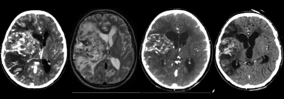 SPIN | Society of Pediatric Neuroimaging (@spinacademics) on Twitter photo The debut of VNC was a masterclass in transnational collaboration,seamlessly bridging time zones with an outstanding presentation by <a href="/JLCCuevasMD/">Jaymie Louise Cuevas</a> and <a href="/Florendobe/">Florendo Jr. Betancor</a>.
A monstrous tumor, venous hypertension or proliferative angiopathy in ?Tuberous Sclerosis-a truly elegant dilemma! The debut of VNC was a masterclass in transnational collaboration,seamlessly bridging time zones with an outstanding presentation by <a href="/JLCCuevasMD/">Jaymie Louise Cuevas</a> and <a href="/Florendobe/">Florendo Jr. Betancor</a>.
A monstrous tumor, venous hypertension or proliferative angiopathy in ?Tuberous Sclerosis-a truly elegant dilemma!