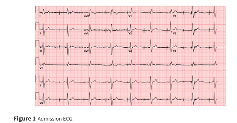 European Society of Cardiology Journals (@esc_journals) on Twitter photo 74/M p/w syncope. He had SA nodal dysfunction w DDDR PPM 10 yrs ago. What is the abnormality & cause? ow.ly/BzAP50VLVZN
#EHJCaseReports <a href="/Phiso_de/">Philipp Sommer</a> <a href="/TJ_Yeo/">Tee Joo YEO</a> <a href="/aayshacader/">Aaysha Cader</a> <a href="/BoldiKovacsMD/">Boldizsar Kovacs</a> <a href="/KardiologieHH/">Erik Rafflenbeul</a> <a href="/ANazmiCalik/">A.Nazmi Calik</a> <a href="/O_Azizy_MD/">Obayda Azizy</a> <a href="/saramoscatelli7/">Sara Moscatelli</a> <a href="/EHJCREiC/">EHJCaseReports Editor-in-Chief</a> #CardioX #EPeeps 74/M p/w syncope. He had SA nodal dysfunction w DDDR PPM 10 yrs ago. What is the abnormality & cause? ow.ly/BzAP50VLVZN
#EHJCaseReports <a href="/Phiso_de/">Philipp Sommer</a> <a href="/TJ_Yeo/">Tee Joo YEO</a> <a href="/aayshacader/">Aaysha Cader</a> <a href="/BoldiKovacsMD/">Boldizsar Kovacs</a> <a href="/KardiologieHH/">Erik Rafflenbeul</a> <a href="/ANazmiCalik/">A.Nazmi Calik</a> <a href="/O_Azizy_MD/">Obayda Azizy</a> <a href="/saramoscatelli7/">Sara Moscatelli</a> <a href="/EHJCREiC/">EHJCaseReports Editor-in-Chief</a> #CardioX #EPeeps