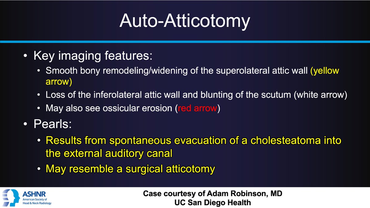 ASHNR (@ashnrsociety) on Twitter photo #ASHNRCOTW #295: ANSWER. Thx Dr. Robinson 4 case! #ASHNR25
<a href="/callyrobs/">Caroline Robson, MBChB</a> <a href="/DShatzkes/">Deborah Shatzkes</a> <a href="/CDP_Rad/">C Douglas Phillips 🇺🇸</a> <a href="/rhwiggins/">Richard Wiggins</a> <a href="/nakoontz/">Nicholas Koontz</a> <a href="/KRileyMD/">Kalen Riley</a> <a href="/CMGlastonbury/">Christine M Glastonbury, MD</a> <a href="/tabby_kennedy/">Tabby A. Kennedy, MD</a> <a href="/PhilipRChapman1/">Philip R. Chapman, MD</a> <a href="/cmtomblinson/">Courtney Tomblinson, MD</a>
<a href="/amyfjuliano/">Amy Juliano</a> <a href="/bpoliceni/">Bruno Policeni</a> <a href="/MohitTCCNeuro/">Mohit Agarwal</a> <a href="/AshokSrini15/">Ashok Srinivasan</a> <a href="/KatieTraylorDO/">Katie S. Traylor MS, DO, DABR</a> <a href="/CynXinWu/">Cynthia Xin Wu</a> #ASHNRCOTW #295: ANSWER. Thx Dr. Robinson 4 case! #ASHNR25
<a href="/callyrobs/">Caroline Robson, MBChB</a> <a href="/DShatzkes/">Deborah Shatzkes</a> <a href="/CDP_Rad/">C Douglas Phillips 🇺🇸</a> <a href="/rhwiggins/">Richard Wiggins</a> <a href="/nakoontz/">Nicholas Koontz</a> <a href="/KRileyMD/">Kalen Riley</a> <a href="/CMGlastonbury/">Christine M Glastonbury, MD</a> <a href="/tabby_kennedy/">Tabby A. Kennedy, MD</a> <a href="/PhilipRChapman1/">Philip R. Chapman, MD</a> <a href="/cmtomblinson/">Courtney Tomblinson, MD</a>
<a href="/amyfjuliano/">Amy Juliano</a> <a href="/bpoliceni/">Bruno Policeni</a> <a href="/MohitTCCNeuro/">Mohit Agarwal</a> <a href="/AshokSrini15/">Ashok Srinivasan</a> <a href="/KatieTraylorDO/">Katie S. Traylor MS, DO, DABR</a> <a href="/CynXinWu/">Cynthia Xin Wu</a>