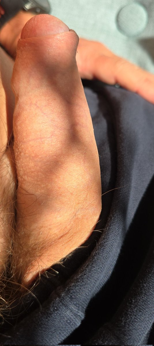 #foreskinfriday
