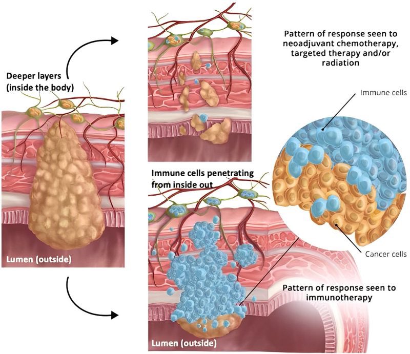 Pashtoon Kasi MD, MS (@pashtoonkasi) on Twitter photo Nothing against radiation☢️but if we can have #immunotherapy like BOT/BAL eradicate/cure cancer, we can set a similar paradigm for our patients with MSS🔵 #ColorectalCancer as is now the case for patients with MSI-High🔴 tumors and spare additional toxicity.
Now <a href="/cityofhope/">City of Hope</a> 👇🏽🙌🏽 Nothing against radiation☢️but if we can have #immunotherapy like BOT/BAL eradicate/cure cancer, we can set a similar paradigm for our patients with MSS🔵 #ColorectalCancer as is now the case for patients with MSI-High🔴 tumors and spare additional toxicity.
Now <a href="/cityofhope/">City of Hope</a> 👇🏽🙌🏽