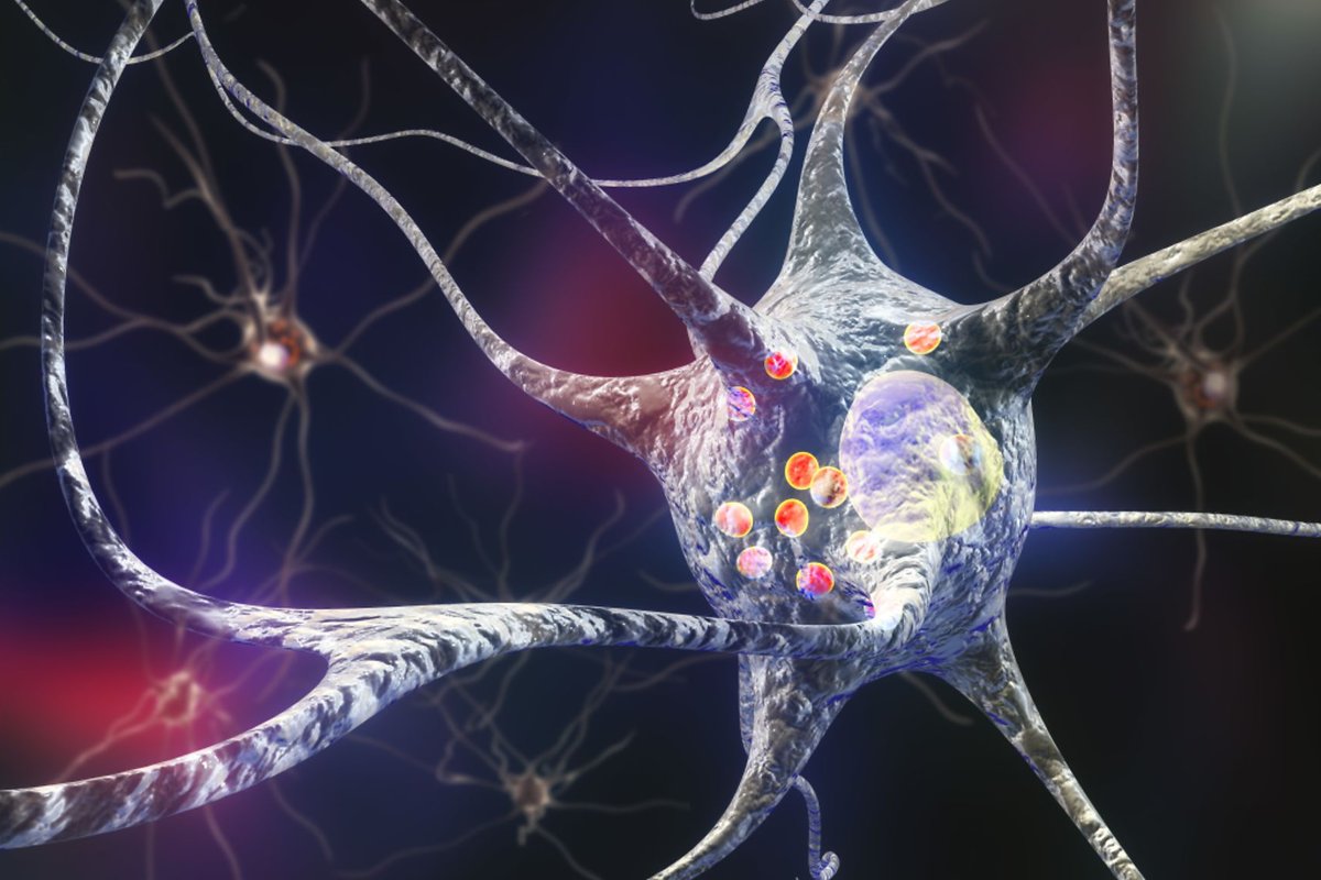 Yale School of Medicine (@yalemed) on Twitter photo In a recent study published in <a href="/NatureCellBio/">Nature Cell Biology</a>, a <a href="/YaleNeuro/">Yale Neuroscience</a> team says mutations in #genes responsible for regulating the lysosome – the "trash can" of the #cell – may result in the leakage of toxic substances in brain cells, leading to #Parkinson's disease onset. In a recent study published in <a href="/NatureCellBio/">Nature Cell Biology</a>, a <a href="/YaleNeuro/">Yale Neuroscience</a> team says mutations in #genes responsible for regulating the lysosome – the "trash can" of the #cell – may result in the leakage of toxic substances in brain cells, leading to #Parkinson's disease onset.