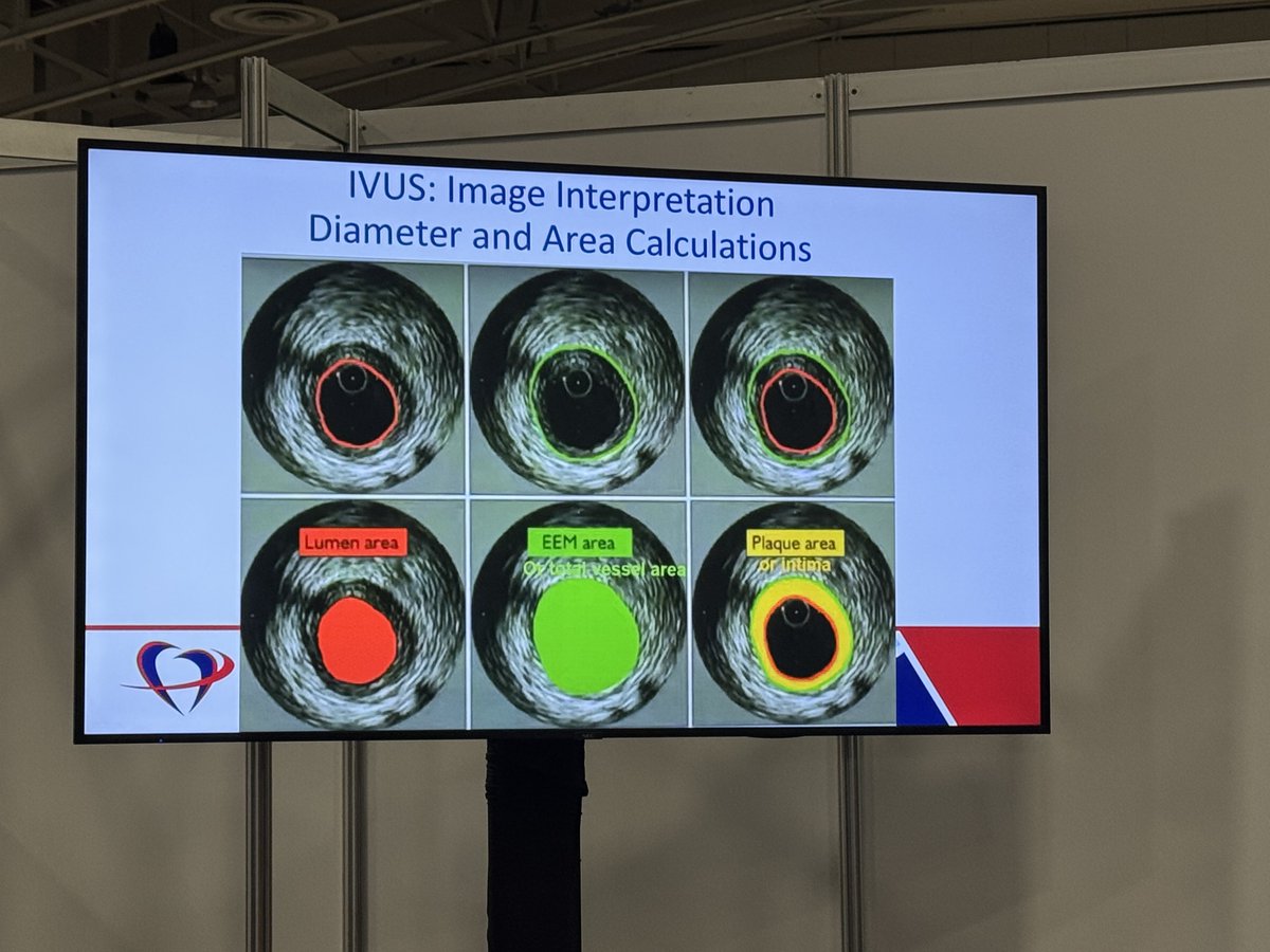 The invaluable role of IVUS in coronary intervention. #SCAI2025