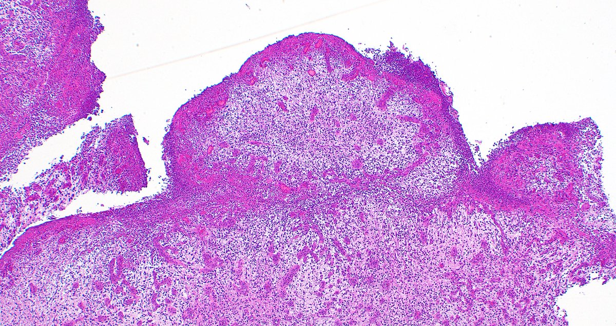 mreyesm's tweet image. &quot;Granulation tissue&quot; is called like that because it forms small granules due to new vessel formation during the wound healing repair. Under the microscope, it looks like what you see in these pictures. #Pathology #GranulationTissue