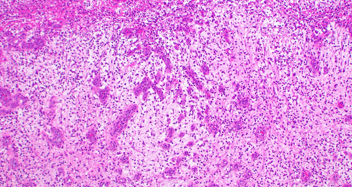 mreyesm's tweet image. &quot;Granulation tissue&quot; is called like that because it forms small granules due to new vessel formation during the wound healing repair. Under the microscope, it looks like what you see in these pictures. #Pathology #GranulationTissue