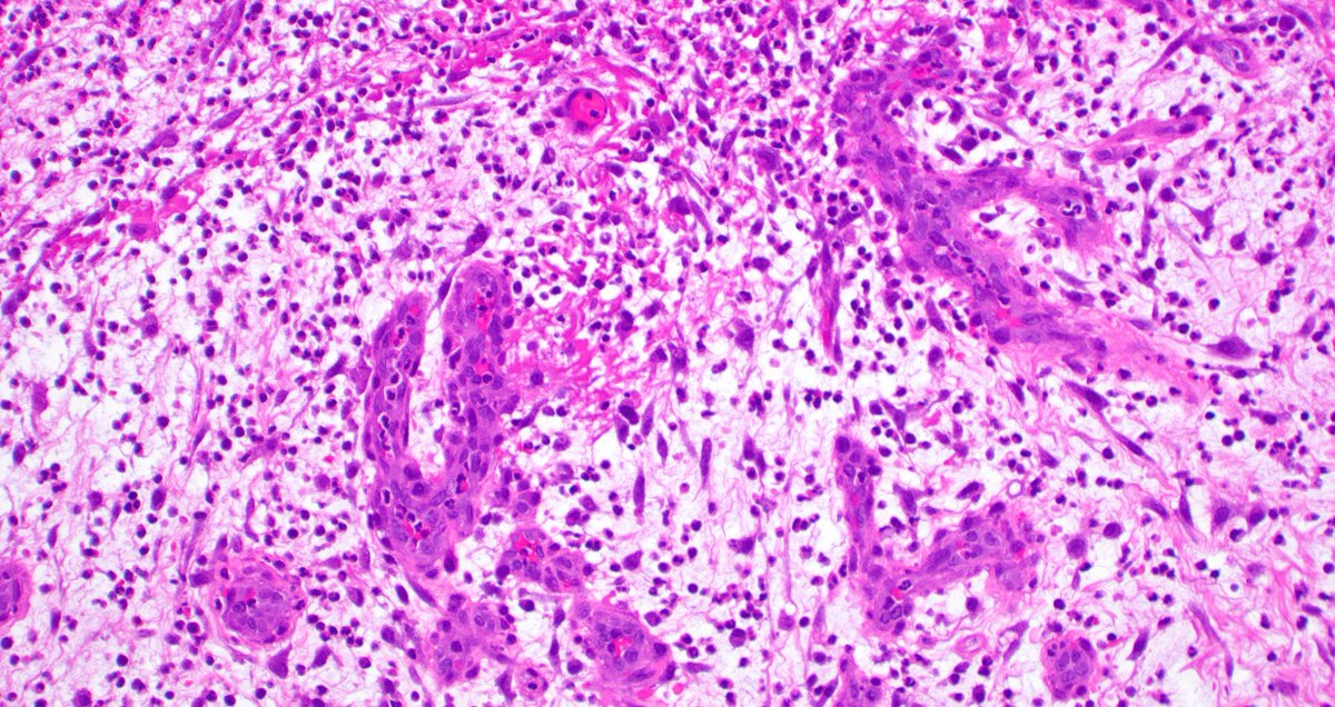 mreyesm's tweet image. &quot;Granulation tissue&quot; is called like that because it forms small granules due to new vessel formation during the wound healing repair. Under the microscope, it looks like what you see in these pictures. #Pathology #GranulationTissue