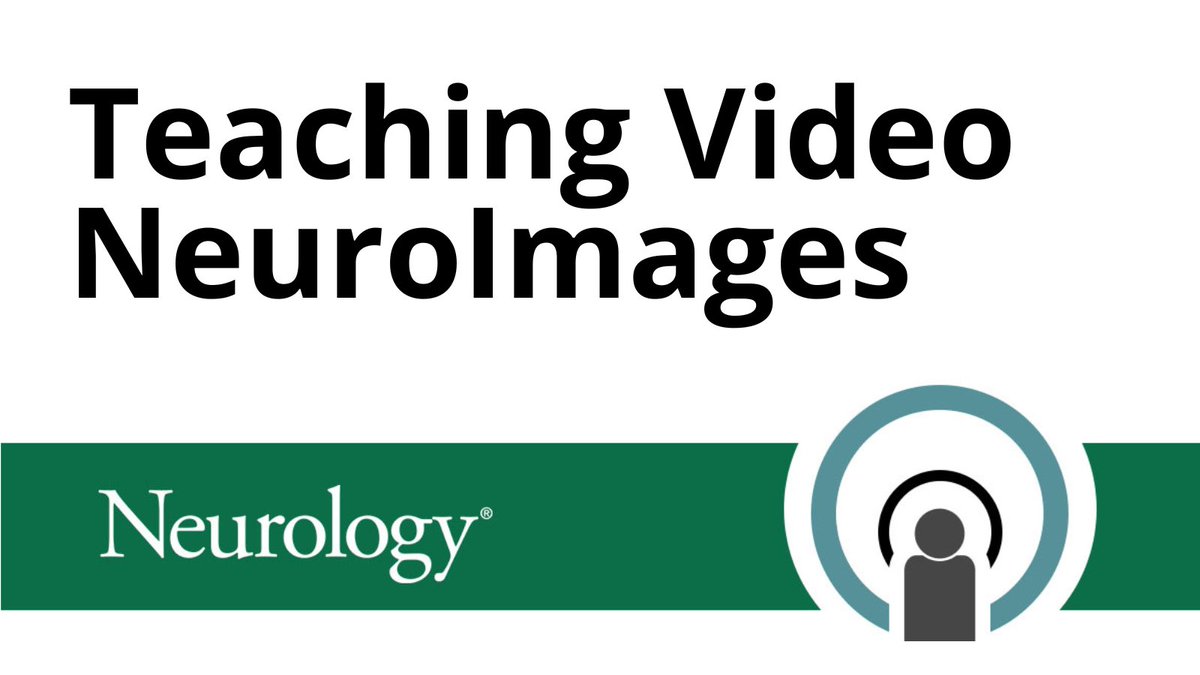 Teaching Video NeuroImage: Touch-Screen Automatisms With Stereotyped Postictal Texting Behavior
hubs.ly/Q03hVFZS0
#NeurologyRF