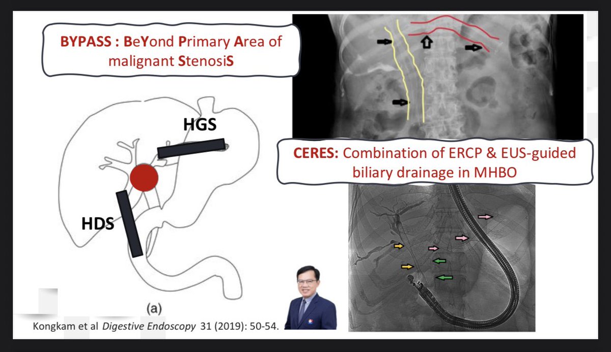 Notts_DrSaqib's tweet photo. Following a masterful live endoscopy demonstration in #PSG2025, an excellent overview on managing malignant hilar strictures by our HPB endoscopy champ @helpatologist 

@abdullahaabbasi @SyedGerdezi @Srisha_Hebbar @jalpa_devi @drnasirjaved1 @KamaniLubna @DrNazishbutt https://t.co/eSVH4PNyRM