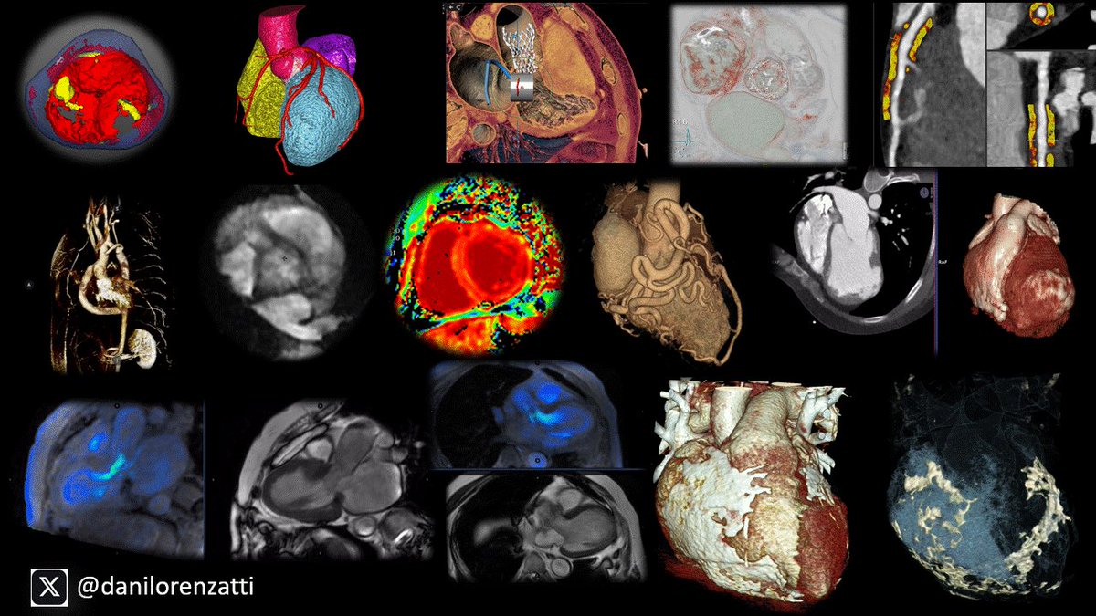 Leandro Slipczuk (@cardiomdphd) on Twitter photo We have an opening for an advanced imaging fellowship position available starting July 2025 at <a href="/MonteHeart/">Montefiore Heart</a>. Applicants that have completed cardiology training are preferred. International applicants with USMLE certification will be considered.
<a href="/aschenonegiugni/">Aldo L Schenone, MD</a> <a href="/CarlosGongoraMD/">Carlos Gongora, MD FACC</a> We have an opening for an advanced imaging fellowship position available starting July 2025 at <a href="/MonteHeart/">Montefiore Heart</a>. Applicants that have completed cardiology training are preferred. International applicants with USMLE certification will be considered.
<a href="/aschenonegiugni/">Aldo L Schenone, MD</a> <a href="/CarlosGongoraMD/">Carlos Gongora, MD FACC</a>