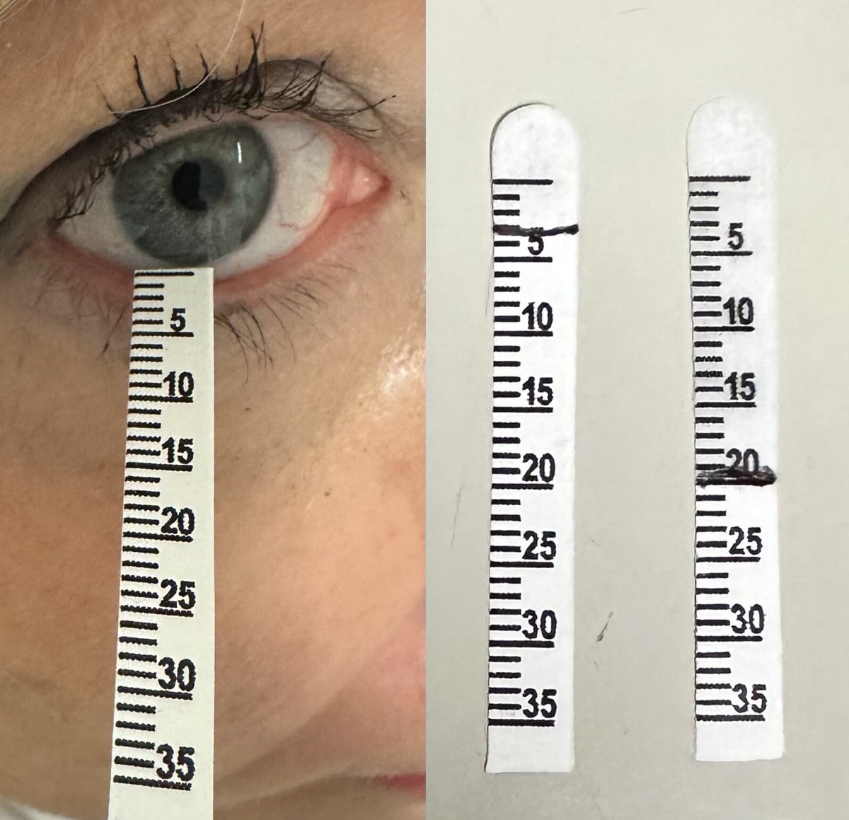 The #Schirmer's test is a widely used clinical tool that helps assess tear production, especially in patients with suspected keratoconjunctivitis sicca, dry eye, or tear overproduction. It is also included among the classification criteria for #Sjögren's disease. 

It was first
