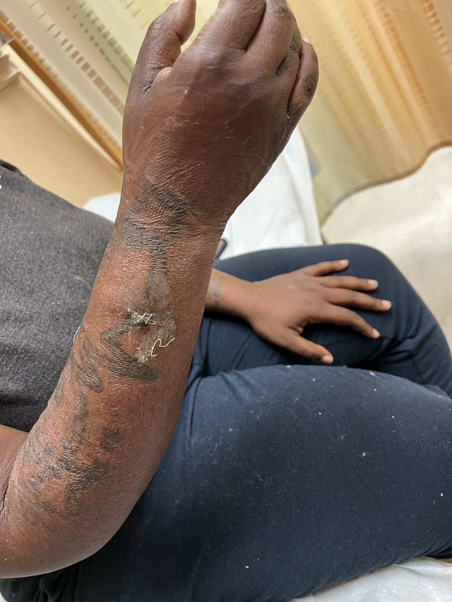 On day 26, the doctors removed my wrist from the splint and staples from my wrist. I was upgraded to a brace that I have to still wear 99% of the time and for another 4 weeks. #MalcolmStrong gofund.me/c3ccce4f