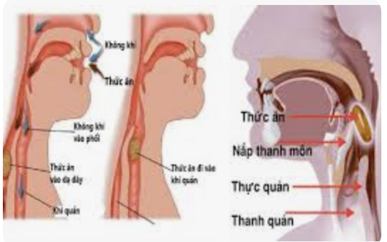 Mùa đông năm trước, Mẹ tôi bị viêm phổi, phải đi cấp cứu rồi nằm viện 10 ngày. Bản thân tôi và mọi người xung quanh đều nghĩ rằng Mẹ bị viêm phổi vì trời lạnh. 
Tuy nhiên, nguyên nhân thật sự lại không phải như vậy. Hôm nay tôi muốn kể lại để chia sẻ