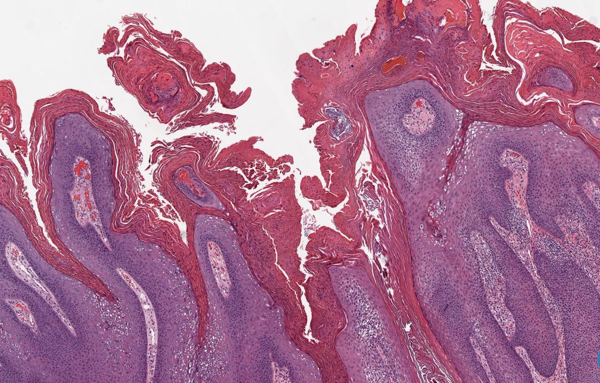 Path4People's tweet image. 25 y/o M with a new skin lesion of forearm.

What is it?  🤔

📸 Credit: Kelly Hall, MD
#pathx #dermpath #fammed #derm