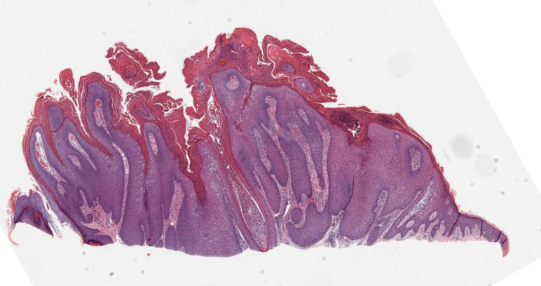 Path4People's tweet image. 25 y/o M with a new skin lesion of forearm.

What is it?  🤔

📸 Credit: Kelly Hall, MD
#pathx #dermpath #fammed #derm