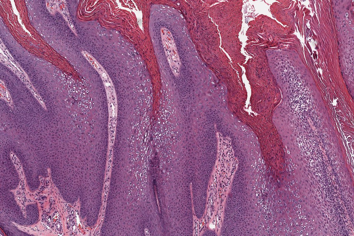 Path4People's tweet image. 25 y/o M with a new skin lesion of forearm.

What is it?  🤔

📸 Credit: Kelly Hall, MD
#pathx #dermpath #fammed #derm