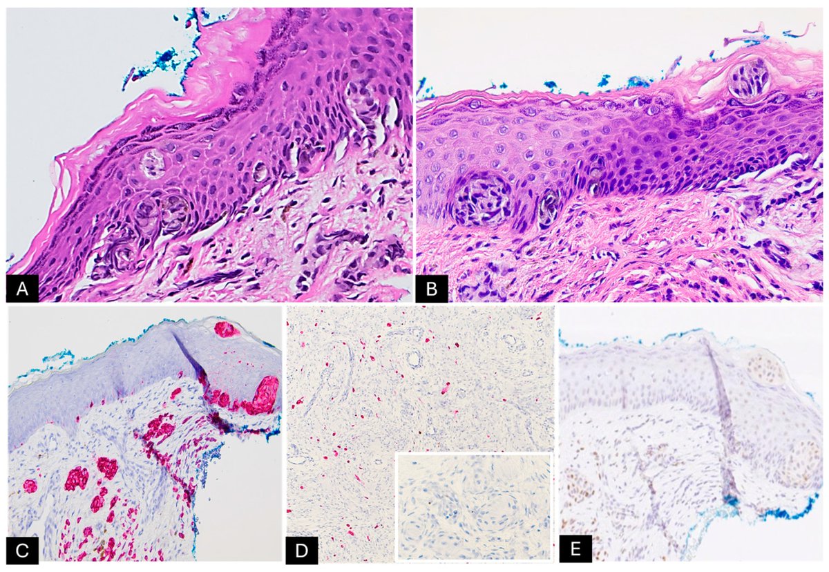 Dermatopathology (@der_mdpi) on Twitter photo 📜#mdpidermatopathology New Publication: Congenital Melanocytic Nevus with Neurocristic Cutaneous Hamartoma: A Case Report
by Alessio Giubellino et al. <a href="/AleGiube/">Alessio Giubellino MD PhD</a> <a href="/gerardo_cazzato/">Gerardo Cazzato Pathologist</a> <a href="/DrSheilagh/">Sheilagh Maguiness</a>
🔗Access for free: mdpi.com/3263412 📜#mdpidermatopathology New Publication: Congenital Melanocytic Nevus with Neurocristic Cutaneous Hamartoma: A Case Report
by Alessio Giubellino et al. <a href="/AleGiube/">Alessio Giubellino MD PhD</a> <a href="/gerardo_cazzato/">Gerardo Cazzato Pathologist</a> <a href="/DrSheilagh/">Sheilagh Maguiness</a>
🔗Access for free: mdpi.com/3263412