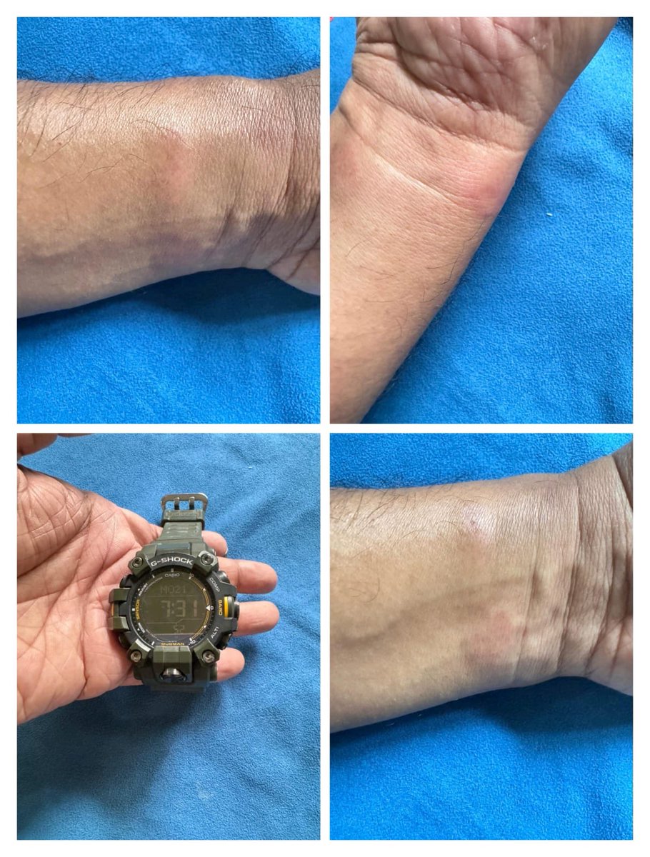 53star's tweet photo. @CasioIndia Do you have solutions for this type of infections or even worse caused  by the resin bands of Casio G-shock watch? https://t.co/yILLtVCbaG