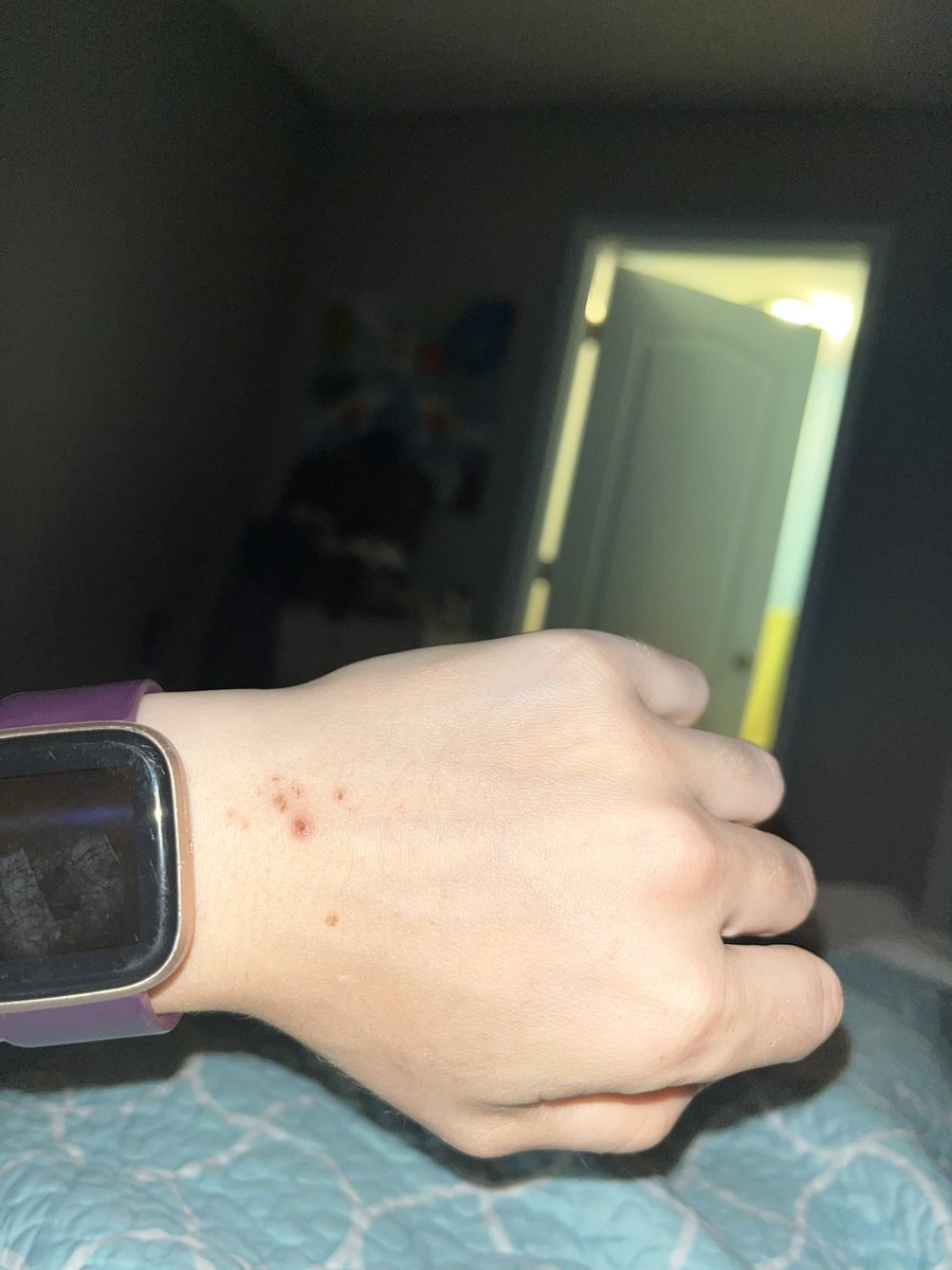 coldhearted4444's tweet photo. Why am I breaking out in hives right where my Fitbit is supposed to sit? 😭😭😭😭😭 it’s my fifth allergic reaction/skin reaction in three days. Whenever I find what’s doing it, trust it will be dealt with. The last photo is from Fridays reaction 😭😭😭 https://t.co/Y6nIYHCA3c