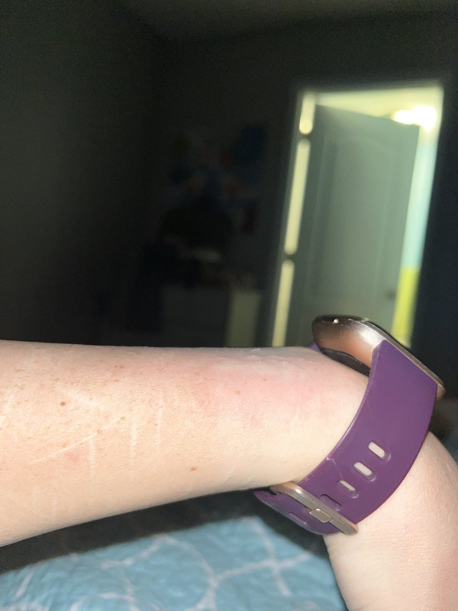 coldhearted4444's tweet photo. Why am I breaking out in hives right where my Fitbit is supposed to sit? 😭😭😭😭😭 it’s my fifth allergic reaction/skin reaction in three days. Whenever I find what’s doing it, trust it will be dealt with. The last photo is from Fridays reaction 😭😭😭 https://t.co/Y6nIYHCA3c