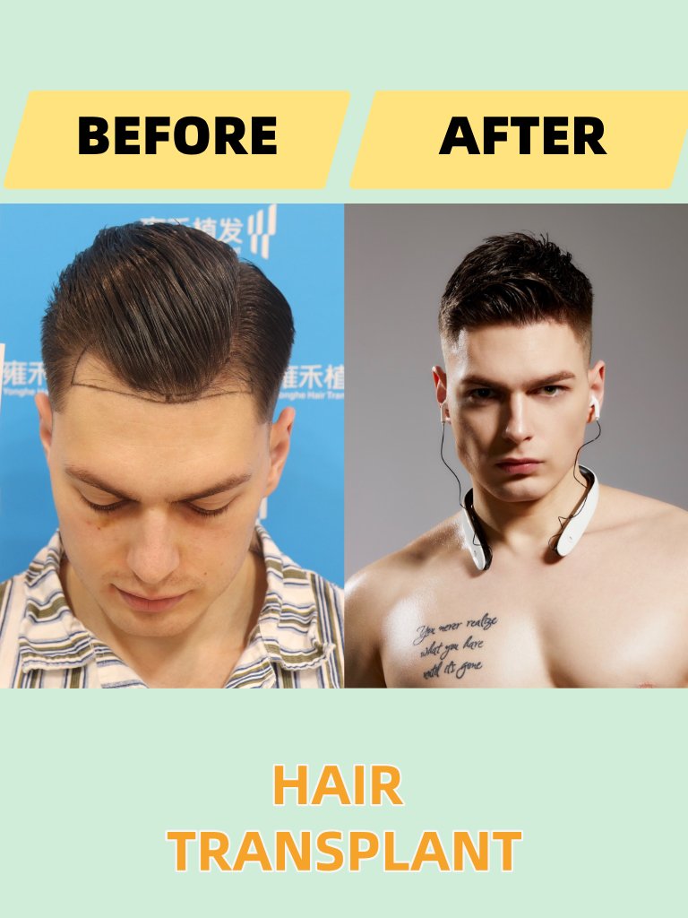 rain79050853's tweet photo. Small adjustments, big changes! Hair transplantation makes people more confident!
-
Consult me ​​about hair transplantation:         
 WeChat: yhzfyl2005           
WhatsApp consultation: https://t.co/7Df8roApcx 
#hairtransplant #hairloss #thinninghair #yonghe #Malebaldness #hairstyle #hairgrowth #Hair
