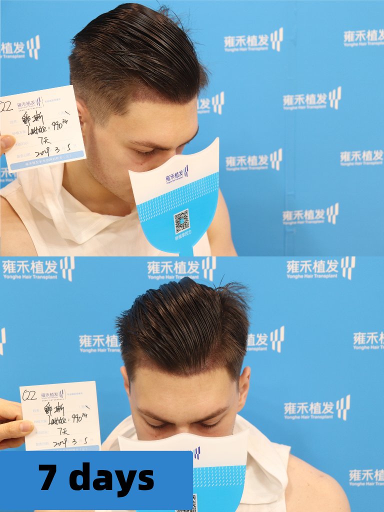 rain79050853's tweet photo. Small adjustments, big changes! Hair transplantation makes people more confident!
-
Consult me ​​about hair transplantation:         
 WeChat: yhzfyl2005           
WhatsApp consultation: https://t.co/7Df8roApcx 
#hairtransplant #hairloss #thinninghair #yonghe #Malebaldness #hairstyle #hairgrowth #Hair