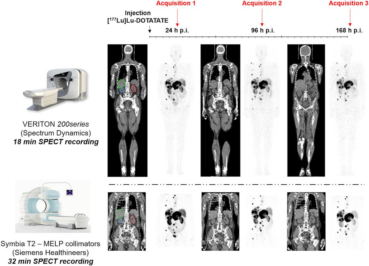 JNM (@journalofnucmed) on Twitter photo Absorbed doses calculated from 360° CZT SPECT are globally comparable to those from conventional SPECT, but CZT SPECT/CT has the advantage of shorter recording times and actual whole-body coverage. ow.ly/PasI50VnjNx
#NuclearMedicine <a href="/CHRU_de_Nancy/">CHRU de Nancy</a> Absorbed doses calculated from 360° CZT SPECT are globally comparable to those from conventional SPECT, but CZT SPECT/CT has the advantage of shorter recording times and actual whole-body coverage. ow.ly/PasI50VnjNx
#NuclearMedicine <a href="/CHRU_de_Nancy/">CHRU de Nancy</a>