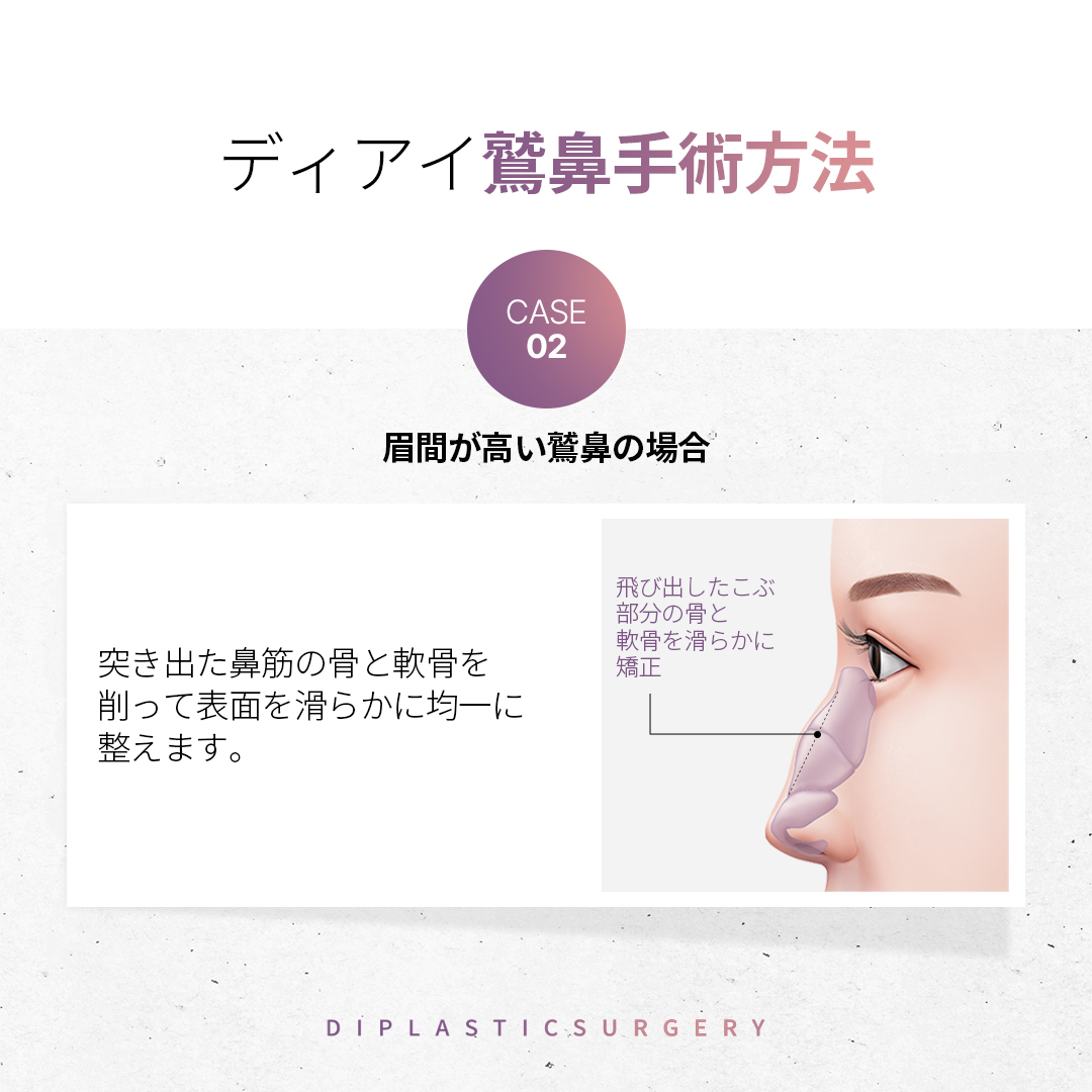 diprsjp's tweet photo. 皆さんが最も気にする顔の部位は何ですか？☺
目や口も大事ですが、鼻が顔の中心を取ってくれると思っている方が多いです。
鼻の形によって印象が大きく変わったりします~！🤓

わし鼻は、鼻の甲が曲がって老けて見えたり、強い印象を与えることがあります。 🤔
韓国では鷹のくちばしのように見えるということで、メブリコの意味でメブリコと呼んでいます。
多くの方が鷲鼻手術で改善したがっています。 🙏🏻🙏🏻

鼻の手術を希望しながら、自然に改善したいという方がいます。
個人の鼻の形と状態によって異なる場合があります。💝
鼻の仕組みを理解し、適切な方法を選択することが重要です。
鼻の形を改善するさまざまな方法が存在し、状態に応じて適切な選択が必要です。🔆🔆

鷲鼻整形は、単に外見だけを改善する手術ではありません。😁
鼻の内部構造と機能的な要素まで一緒に考慮して進行しなければならない高難度の手術です。
鼻の中の構造のねじれにより比重格が曲がっている場合には鼻炎や呼吸の不便を感じることがあり
睡眠の質にも影響を与えることができました。 🙂

特に呼吸が円滑でない場合、慢性的な疲労感や
集中力の低下につながりかねないため、単に美容的な
理由だけでなく、機能的変化のためにも管理を考慮する必要があります。

それでは重要なことは何でしょうか？😎🩷
-診断および計画樹立
-折骨術による矯正
-鼻中隔延長術並行
-鼻の内部機能を改善

病院を選ぶ時は、単に価格や広告だけで決めるのではなく
医療スタッフの経験と実力を几帳面に確認しなければなりません。 🫡🫡
3D-CT撮影を通じて精密な診断と計画を立てる病院を選択することをお勧めします。
また、手術前の相談を通じて医療スタッフと十分にコミュニケーションを図り
自分の顔に最適なデザインを決めることが大切なこと、忘れないでください！🤗🤗

@574lbeop https://t.co/YpKlZ5bLE2 

#韓国整形外科 #韓国鼻整形 #韓国整形 #韓国鼻手術 #韓国整形情報 #韓国整形症例 #鼻整形症例 #韓国鼻整形症例 #鼻フル #団子鼻 #短い鼻 #自己肋軟骨 #鼻肋軟骨 #肋軟骨手術 #鼻手術 #鼻整形 #鼻再手術 #ハンプ手術 #ハンプ鼻 #ハンプ鼻手術 #鼻整形 #韓国鼻整形 #プロテーゼ #鼻中隔延長 #韓国鼻整形おすすめ #韓国整形外科おすすめ #韓国整形外科 #DI整形外科