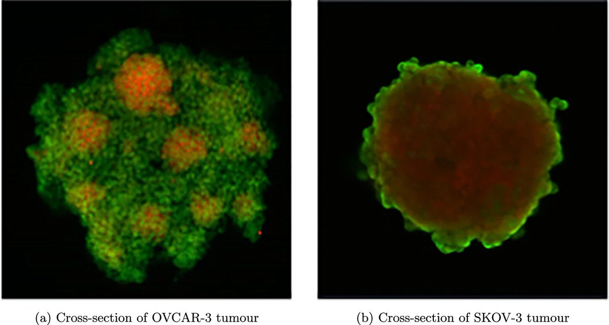 Mohit Kumar Jolly (@mkjolly15) on Twitter photo Glad to have contributed to this work led by <a href="/Sam_M_Oliver/">Sam Oliver</a> <a href="/GibinPowathil/">Gibin Powathil</a> on 3D multi-scale modeling of ovarian cancer heterogeneity. Grateful to <a href="/ictstifr/">ICTS</a> mathematical oncology 2024 meeting & Global Wales-IISc joint fund for supporting this collaboration. nature.com/articles/s4154… Glad to have contributed to this work led by <a href="/Sam_M_Oliver/">Sam Oliver</a> <a href="/GibinPowathil/">Gibin Powathil</a> on 3D multi-scale modeling of ovarian cancer heterogeneity. Grateful to <a href="/ictstifr/">ICTS</a> mathematical oncology 2024 meeting & Global Wales-IISc joint fund for supporting this collaboration. nature.com/articles/s4154…