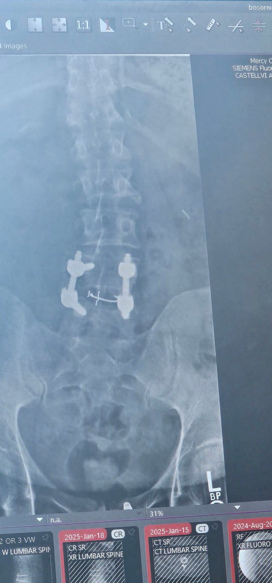 hooverhawg5's tweet image. 3 month post op today. 

DR has lifted restrictions and said I&apos;m on my way to getting my life back. I&apos;m very thankful and happy. Best I have felt in over a decade. #SpinalFusion