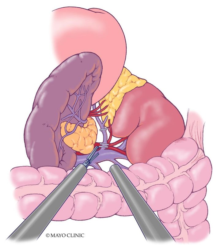 Mayo Clinic Florida General Surgery Program (@mayojaxgensurg) on Twitter photo Surgeons who perform six or more adrenalectomies per year statistically have better outcomes. #MayoClinicFL performs more than 60 adrenalectomies a year, and nearly 90% of these procedures are performed robotically. <a href="/FernandoElliMD1/">E. Fernando Elli MD FACS</a>
bit.ly/42BvtxK Surgeons who perform six or more adrenalectomies per year statistically have better outcomes. #MayoClinicFL performs more than 60 adrenalectomies a year, and nearly 90% of these procedures are performed robotically. <a href="/FernandoElliMD1/">E. Fernando Elli MD FACS</a>
bit.ly/42BvtxK