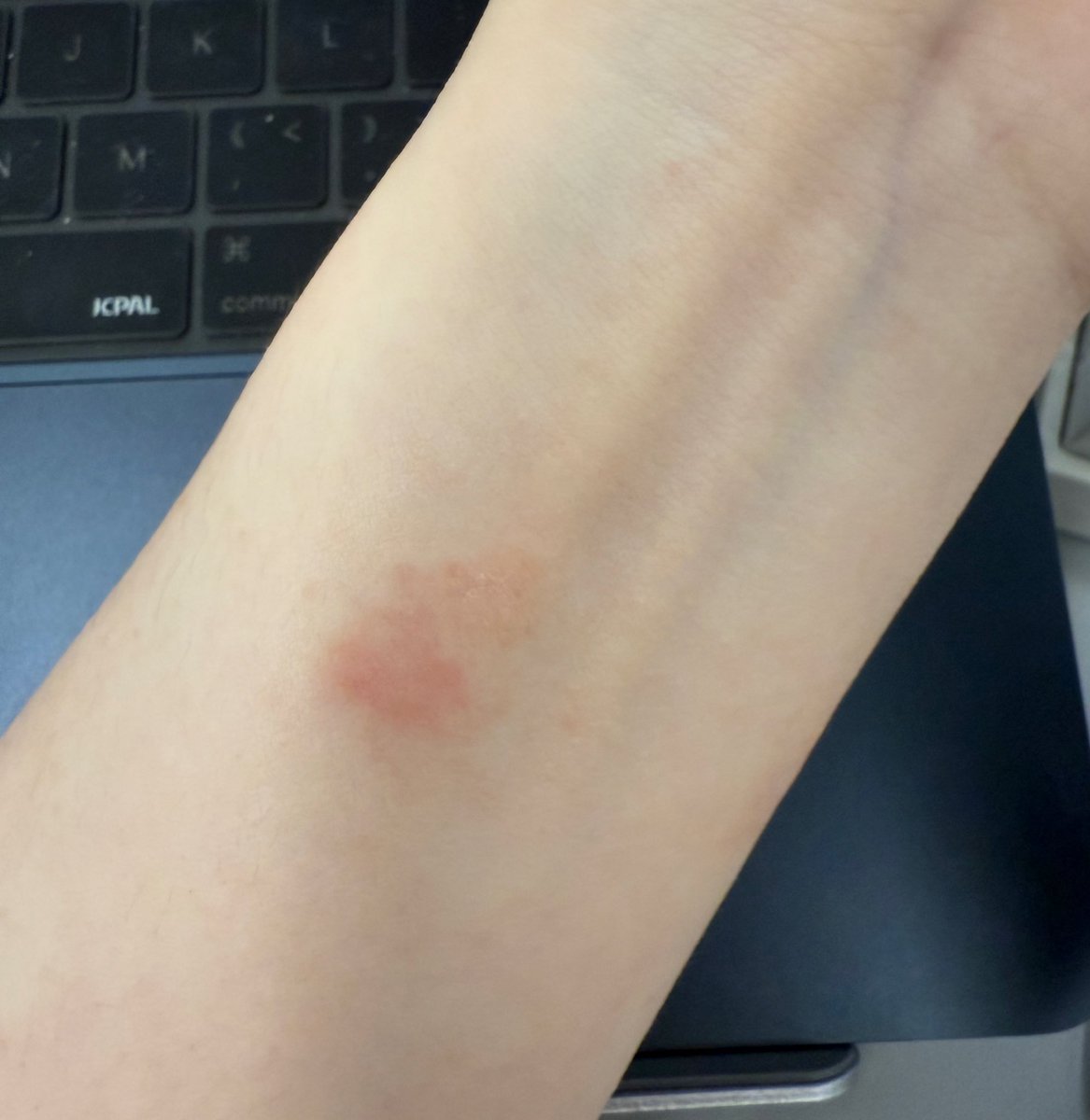 Summer30045246's tweet photo. 天气热一点一戴Apple Watch 的硅胶表带就过敏，真服了，看来是得换了😑 https://t.co/126S9HCRmN