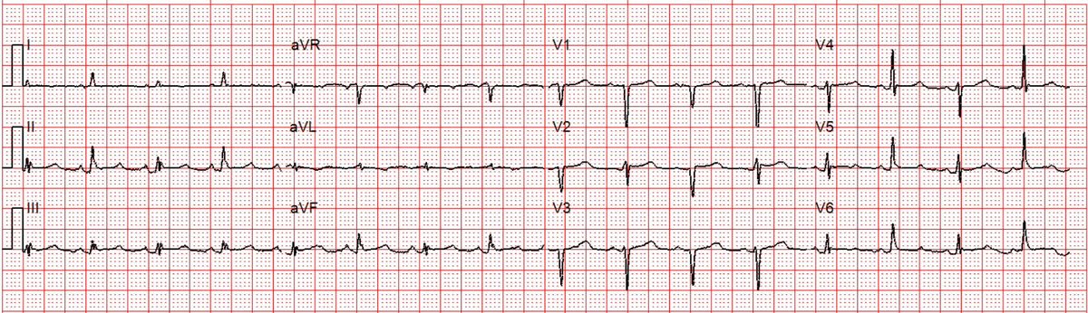 Stephen W. Smith (@smithecgblog) on Twitter photo An elderly patient with shortness of breath and near syncope
hqmeded-ecg.blogspot.com/2025/04/an-eld…
<a href="/PendellM/">Pendell Meyers</a> An elderly patient with shortness of breath and near syncope
hqmeded-ecg.blogspot.com/2025/04/an-eld…
<a href="/PendellM/">Pendell Meyers</a>