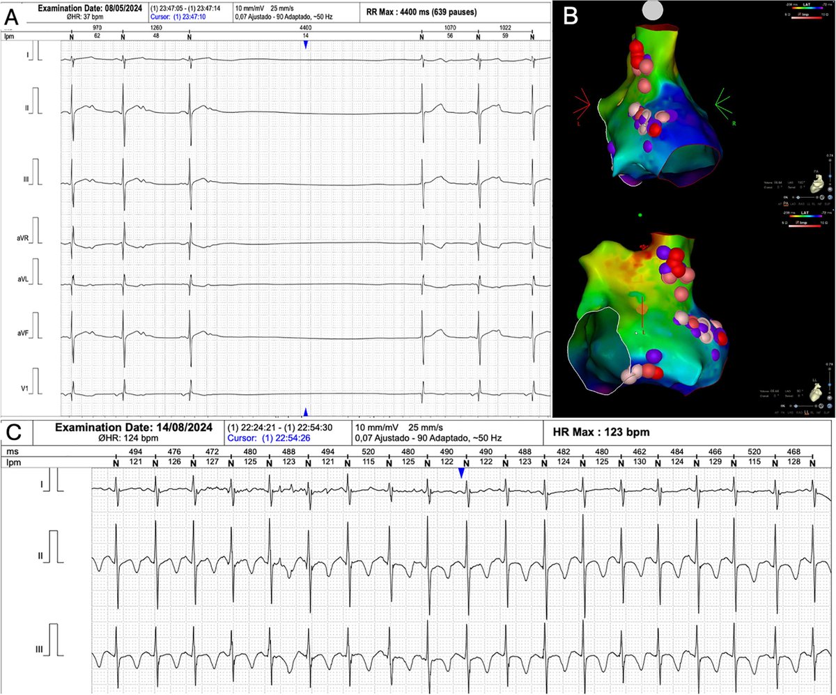 Cardioneuroablation in Pediatric Patients with Functional Bradycardia: A Two-Case Report 
heartrhythmcasereports.com/article/S2214-…